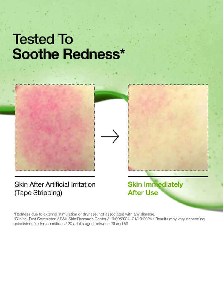 Tested to soothe redness shown in skin before and after using ANUA Azelaic Acid 10 Hyaluron Redness Soothing Serum 30ml.