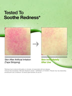 Tested to soothe redness shown in skin before and after using ANUA Azelaic Acid 10 Hyaluron Redness Soothing Serum 30ml.