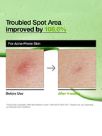 Troubled Spot Area improved by 108.6% for acne-prone skin before and after using ANUA Azelaic Acid 10 Hyaluron Redness Soothing Serum 30ml.