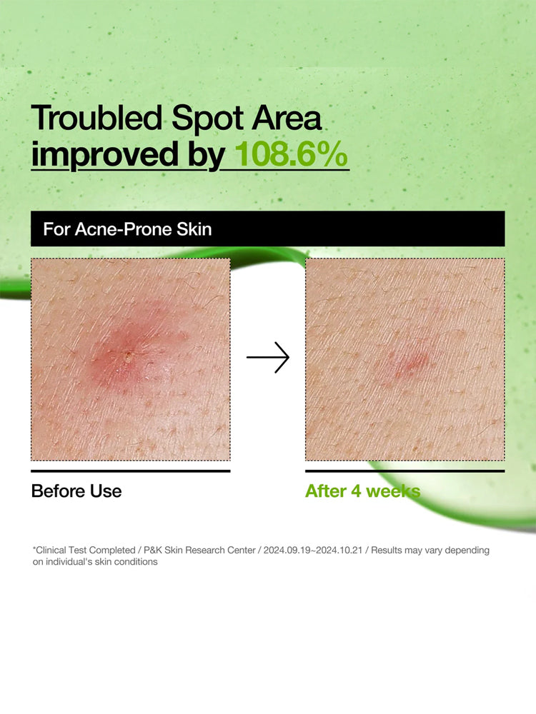 Troubled Spot Area improved by 108.6% for acne-prone skin before and after using ANUA Azelaic Acid 10 Hyaluron Redness Soothing Serum 30ml.