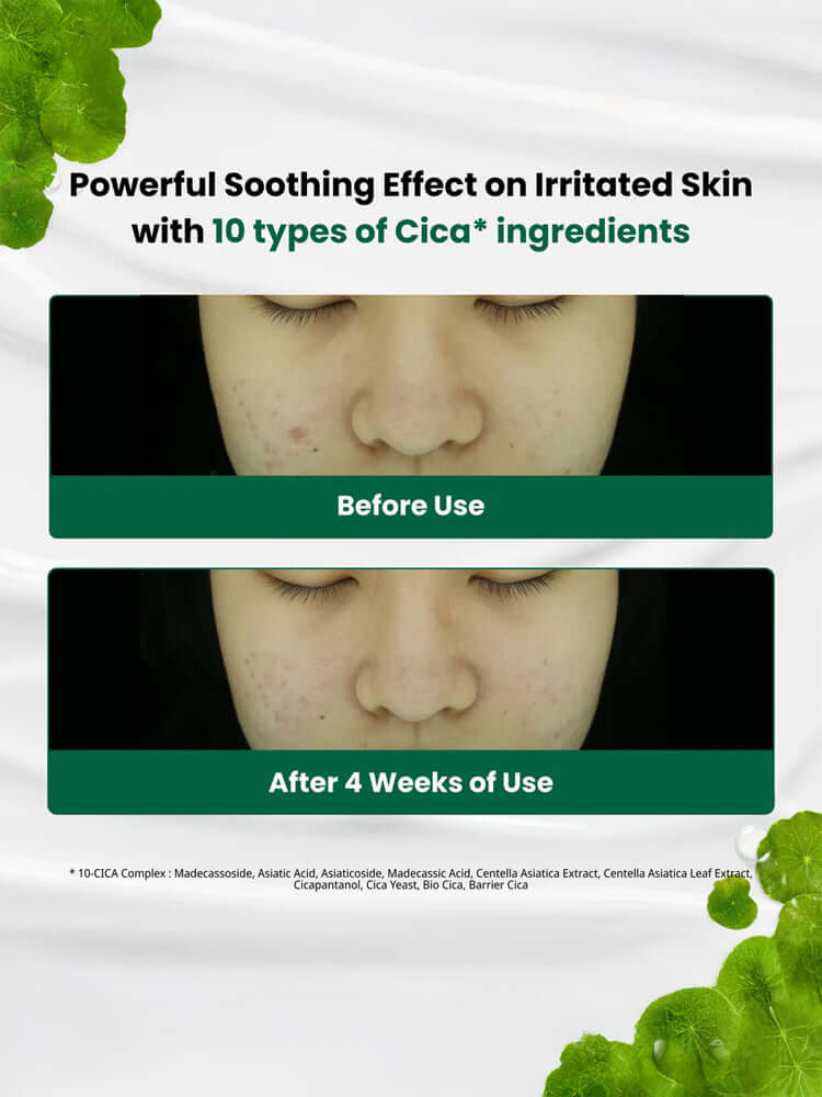 Before and after comparison showing the powerful soothing effect on irritated skin using DR.G R.E.D Blemish Clear Soothing Cream 70ml.