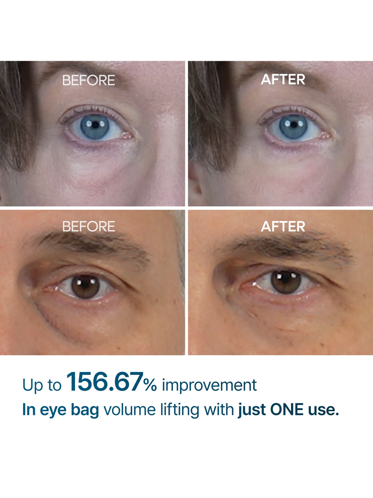 Before and after results showing Dr.MELAXIN Eyephalt Eyebag Cream effectiveness on under-eye bags with 156.67% improvement.