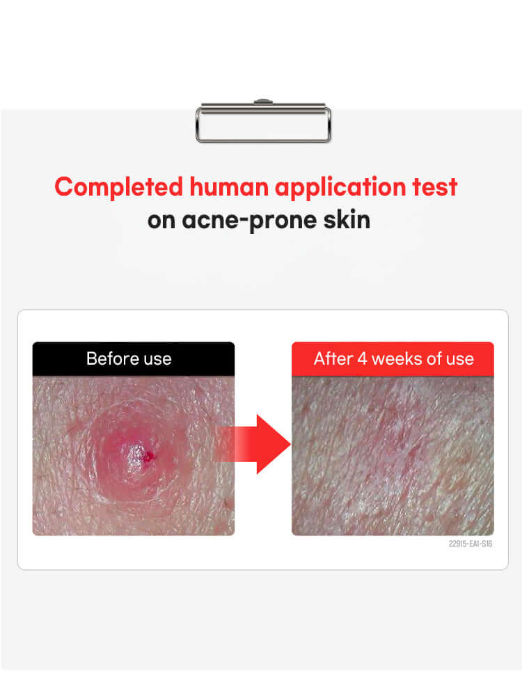 Before and after image showing results of FATION Nosca9 Spot Patch 102ea on acne-prone skin.