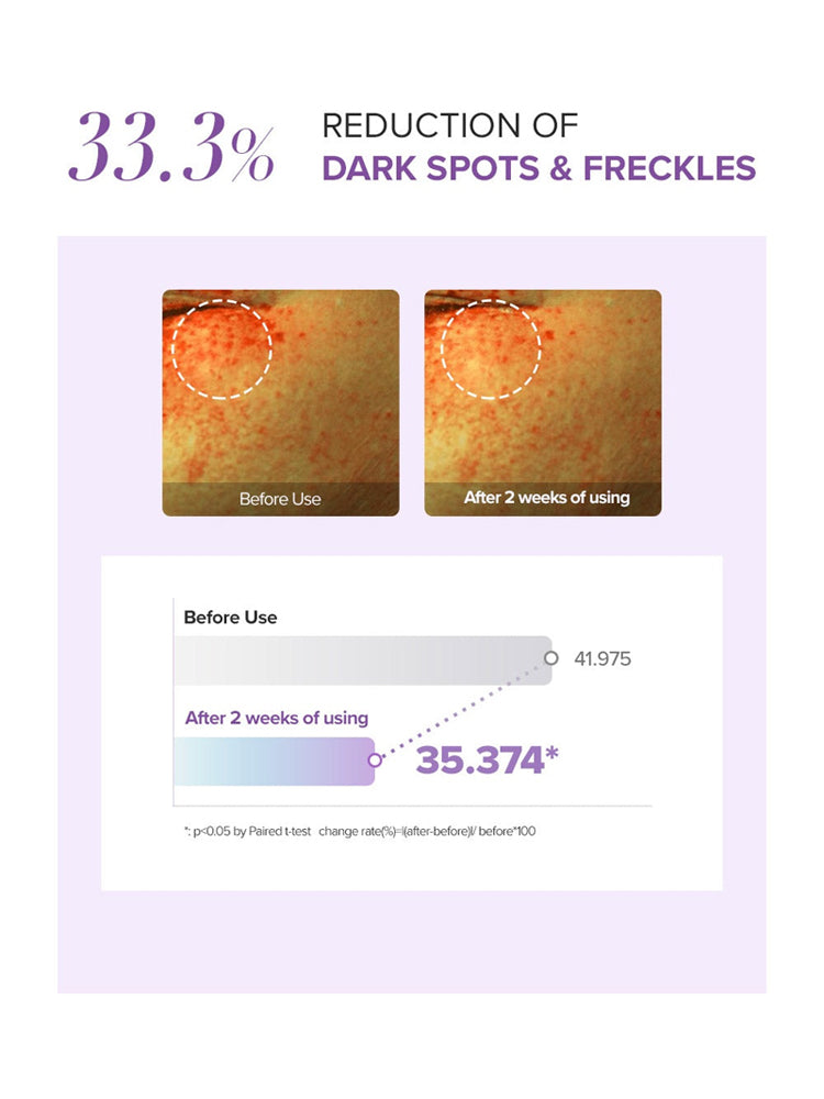 Before and after results showing 33.3% reduction of dark spots and freckles after using glutathione eye cream set.