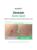 Before and After images showing Diminish Acne Spot results on acne-prone skin. Soothing care effective in 2 weeks.