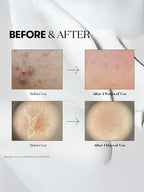 Before and after results using VT Reedle Shot 100 50ml for skin improvement over 4 weeks and 4 days.