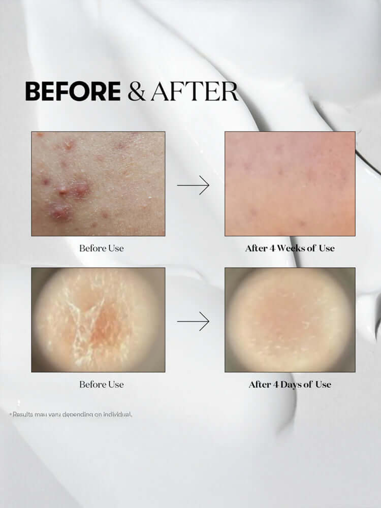 Before and after results using VT Reedle Shot 100 50ml for skin improvement over 4 weeks and 4 days.